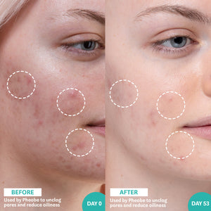 Before and After image of woman using Salicylic Acid and Sea Kelp product