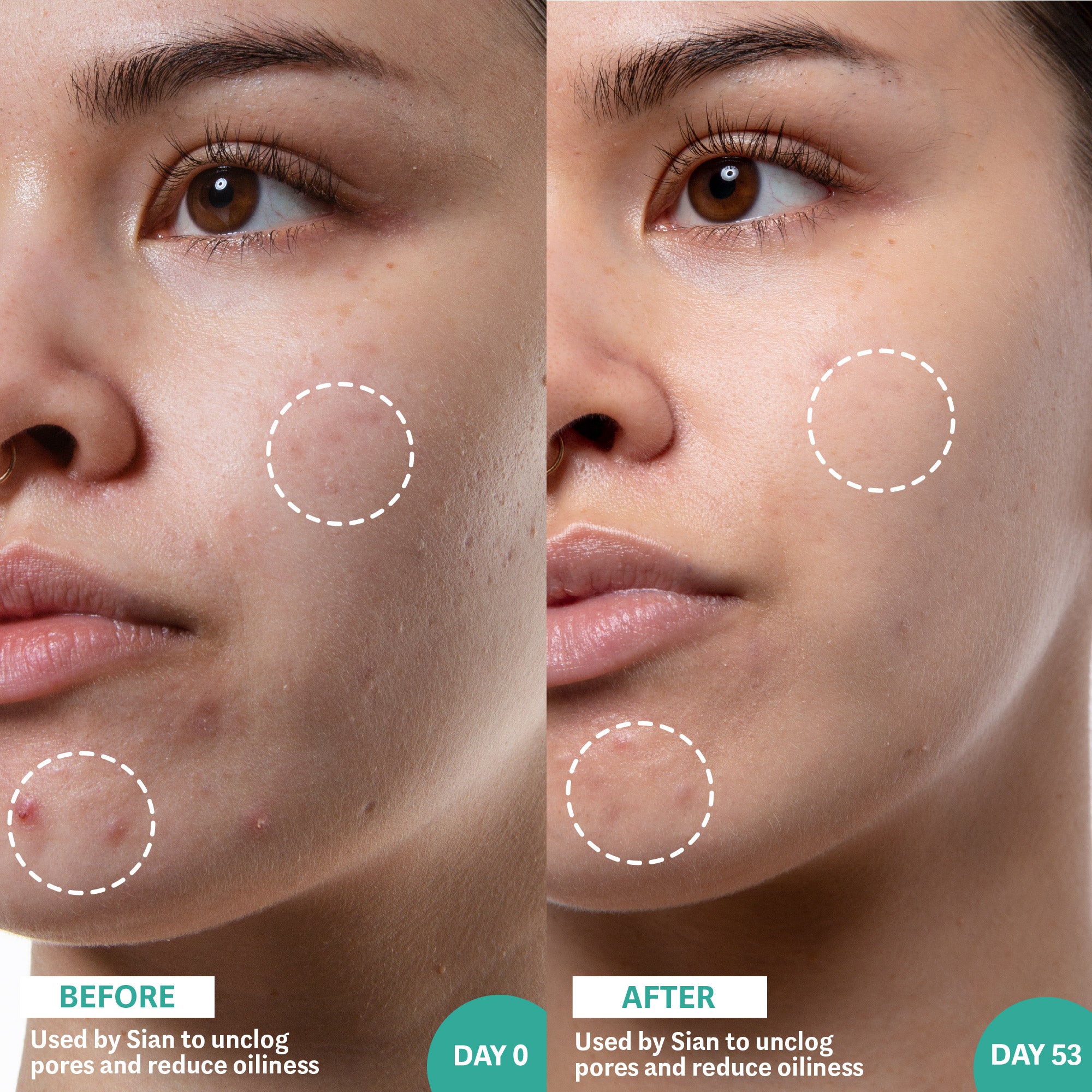 Before and After image of woman using Salicylic Acid and Sea Kelp product